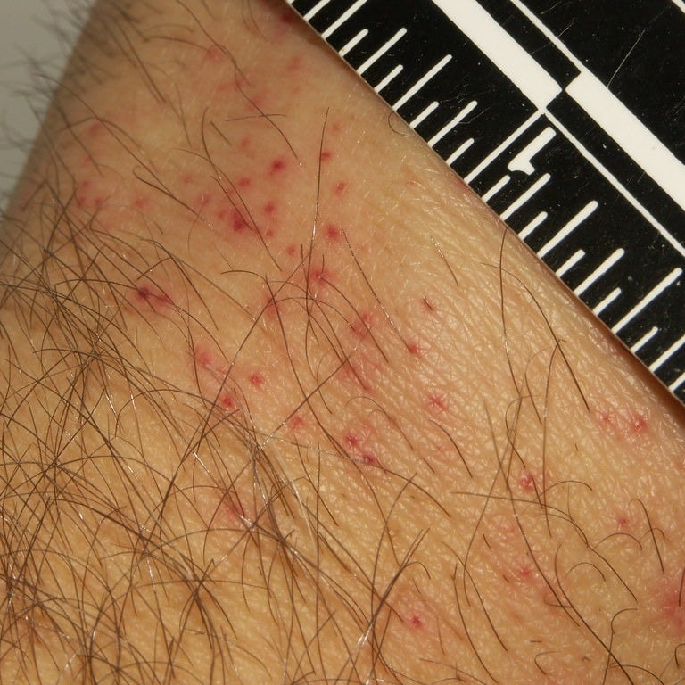 bed bug bites on persons arm