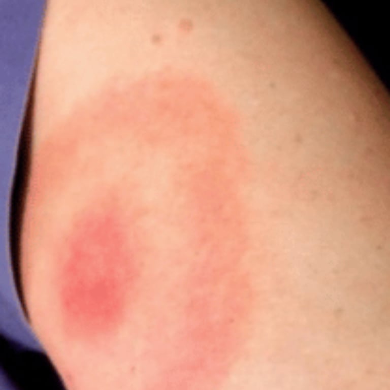 erupcion cutanea de la picadura de una garrapata