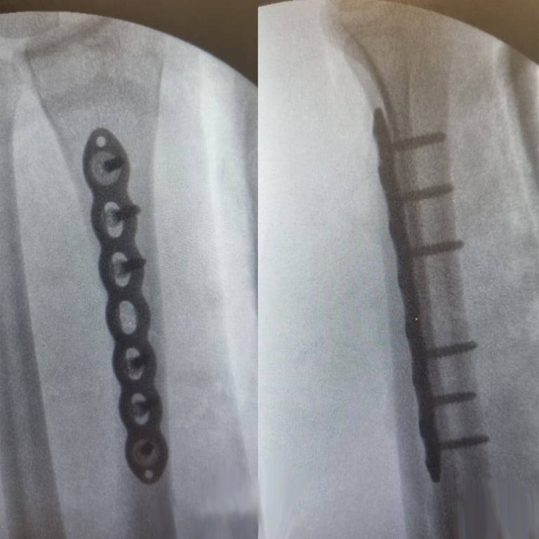 Mike MTB INJURY Broken Arm Plates Twisted Oaks 04-05-2024