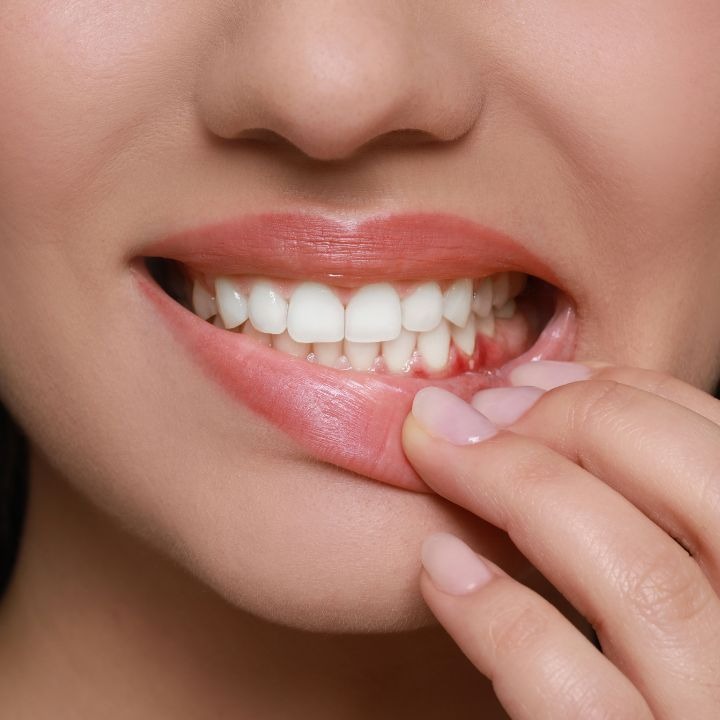 bleeding gums