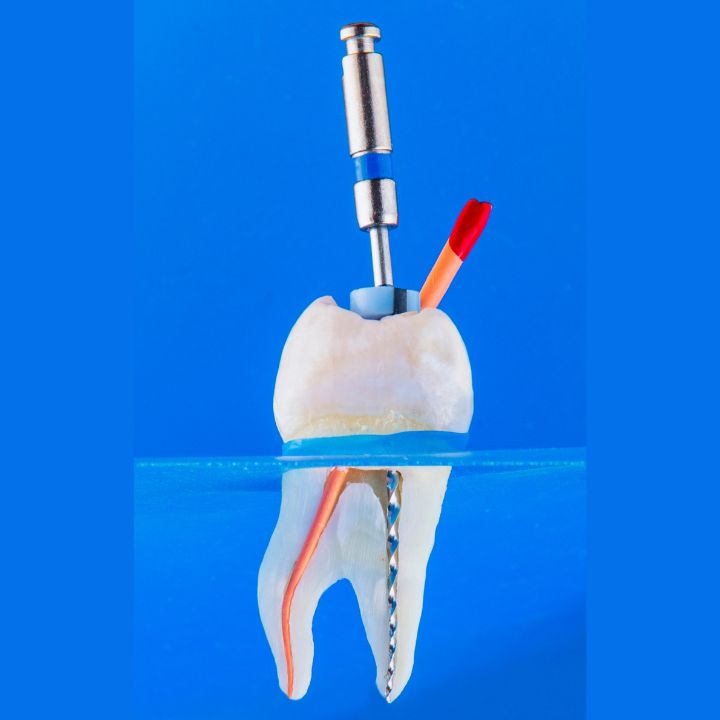 root canal treatment