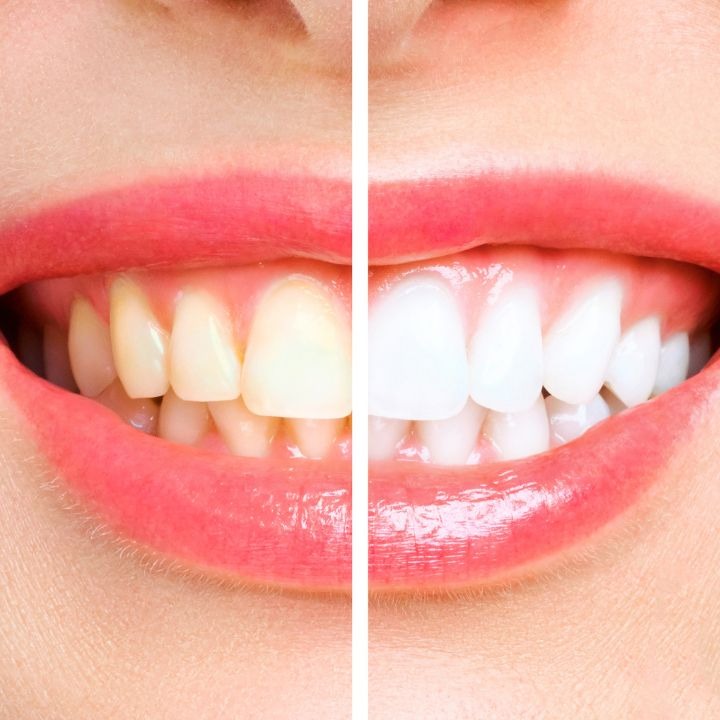 teeth whitening