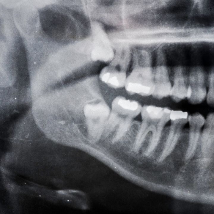 wisdom teeth