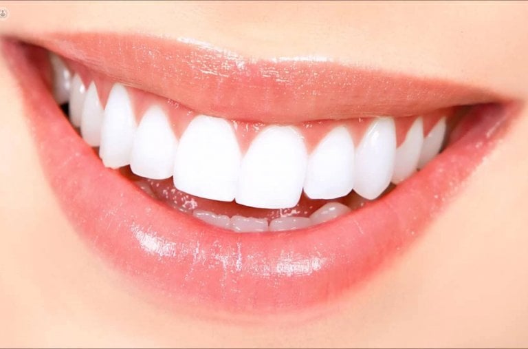 Carillas dentales 
