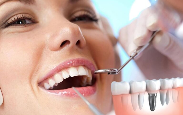 Implantes dentales
