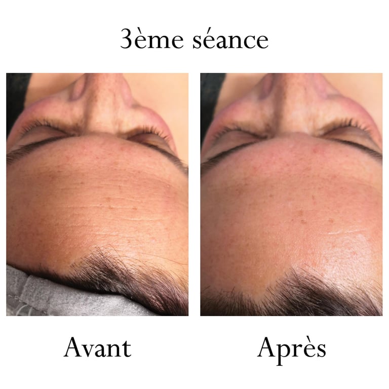 Endospheres Therapy Front