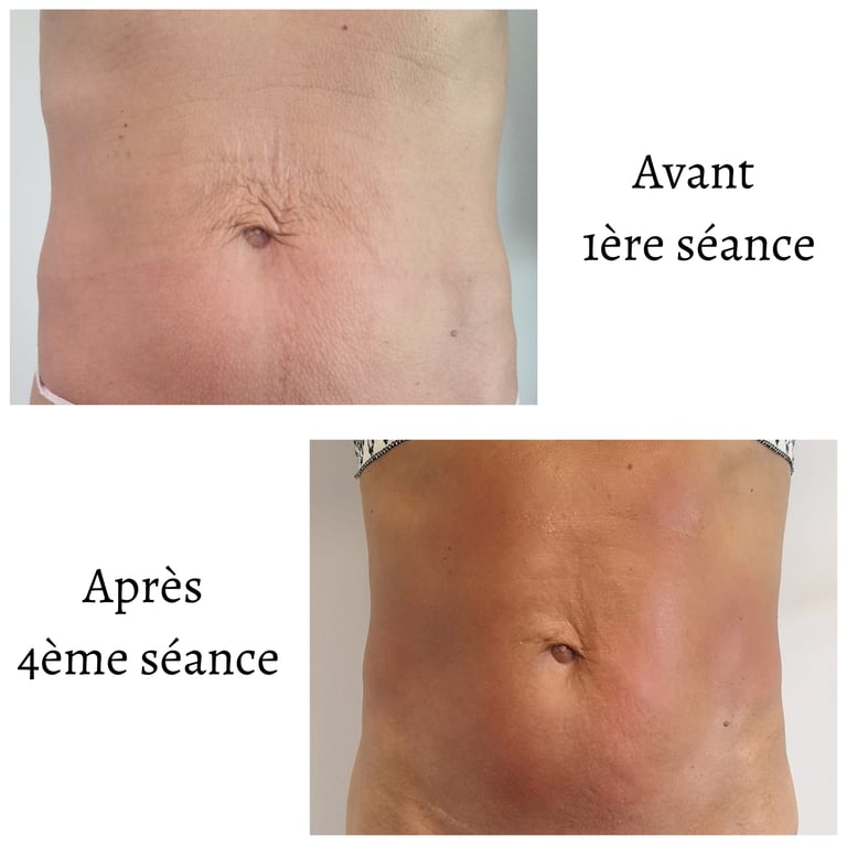 Radiofréquence Ventre