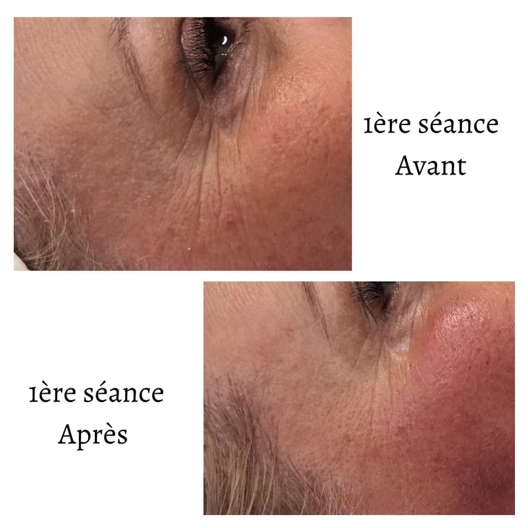 Endospheres Therapy Yeux