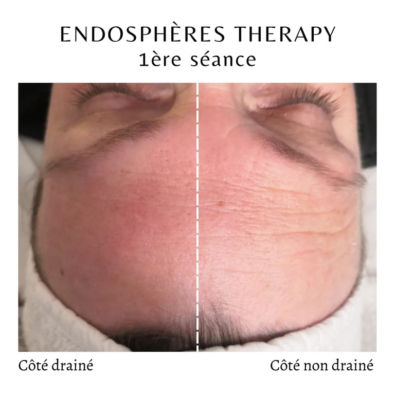 Endospheres Therapy Front