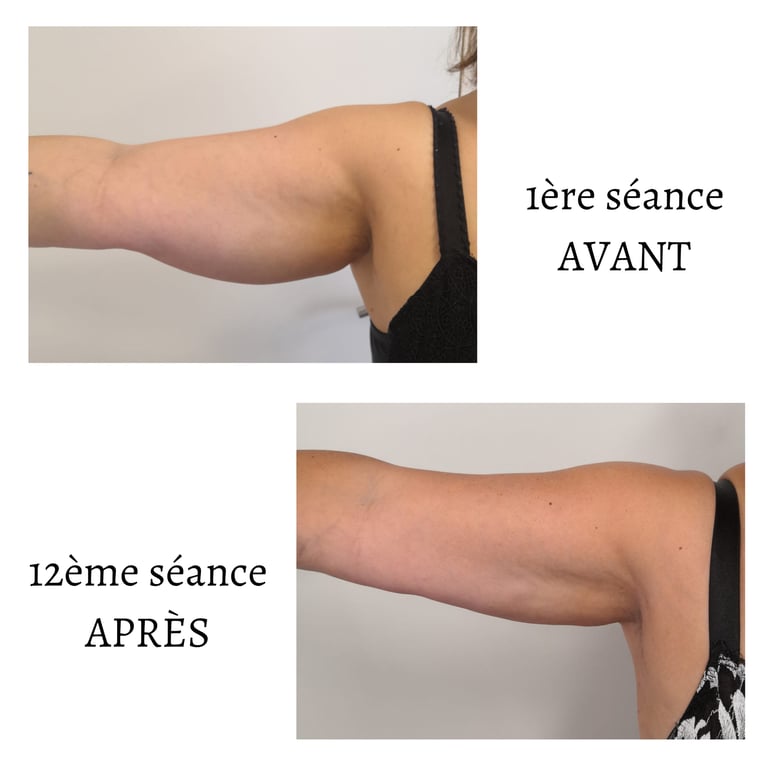 Endospheres Therapy Bras