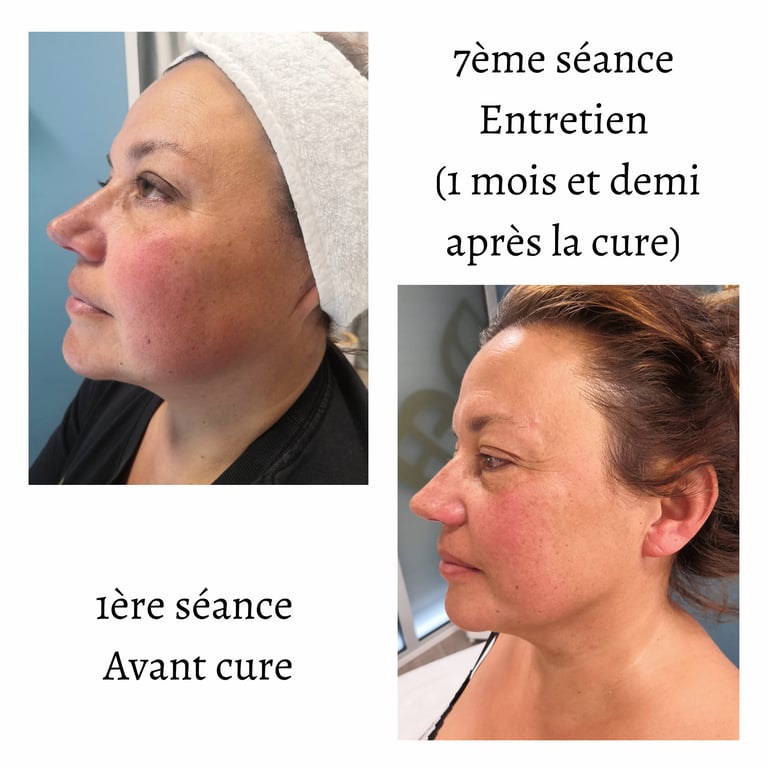 Endospheres Therapy Visage