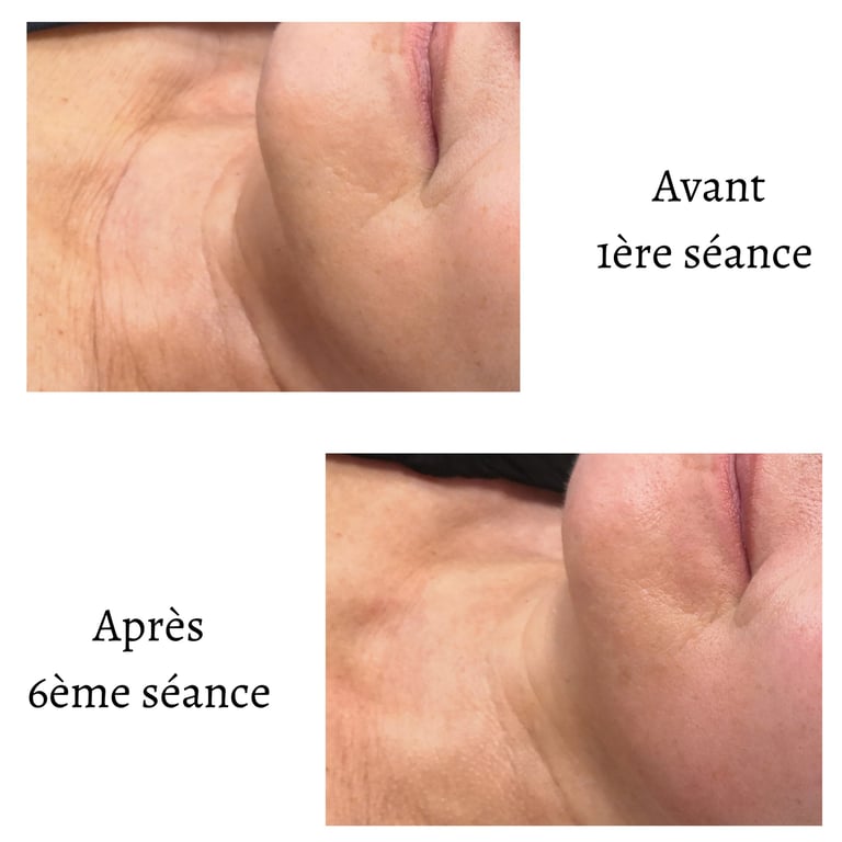 Endospheres Therapy Cou