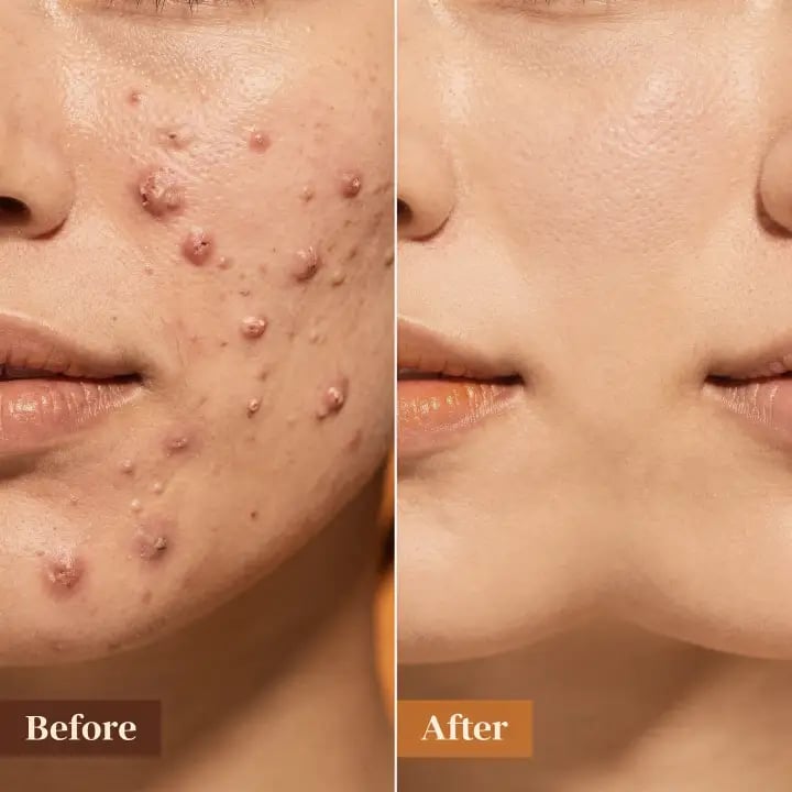 Trattamenti Mesopeeling acne ed iperfezioni del viso Lilium Palermo