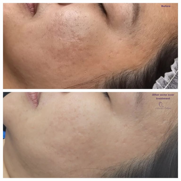 Acne scar treatment at Ariana Esthetic in Edmonton