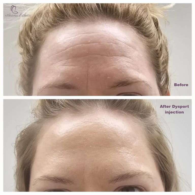 Dysport injection at Ariana Esthetic in Edmonton