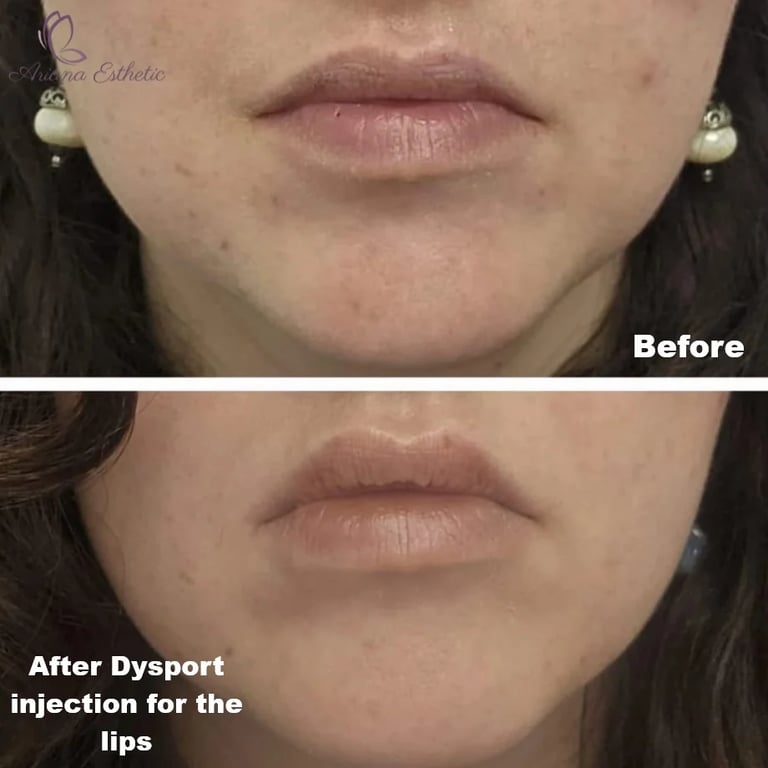 Dysport injection for the lips at Ariana Esthetic in Edmonton