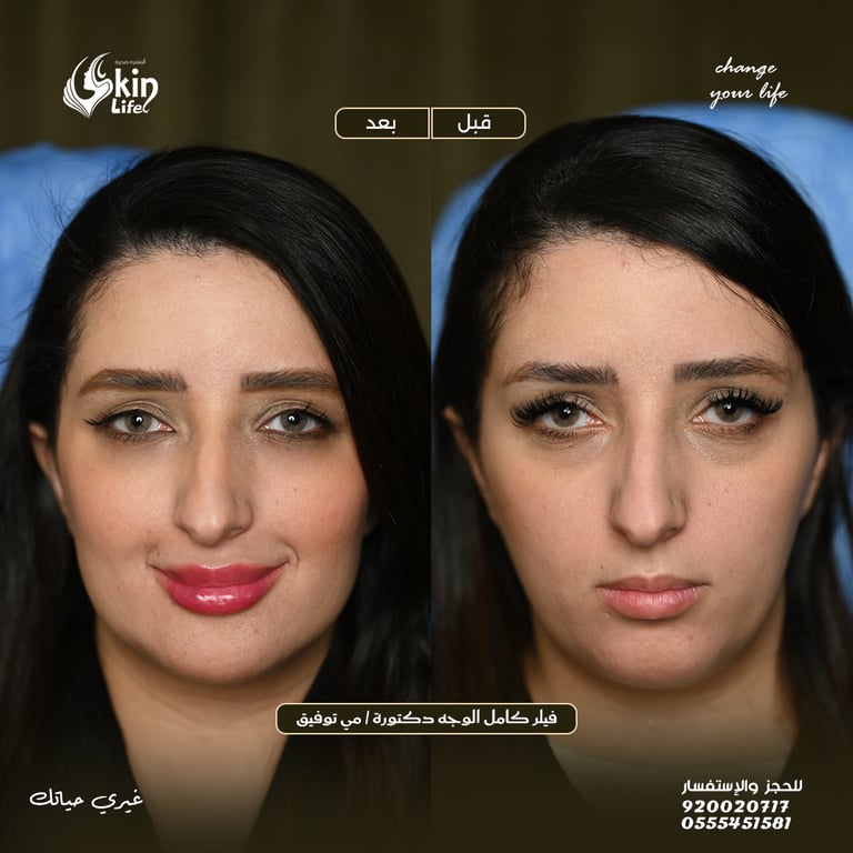 “نتائج فيلر شفايف طبيعية قبل وبعد – مركز Skin Life.”