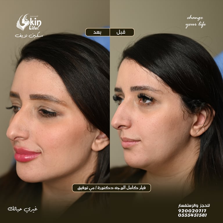 “صورة قبل وبعد فيلر شفايف وخدود لرفع وتحديد الوجنتين – Skin Life Clinic.”