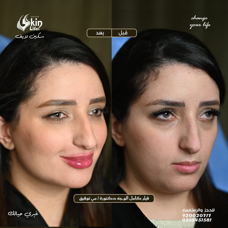“صورة قبل وبعد علاج الفيلر لملء الخدود وتحسين ملامح الوجه – Skin Life Clinic.”