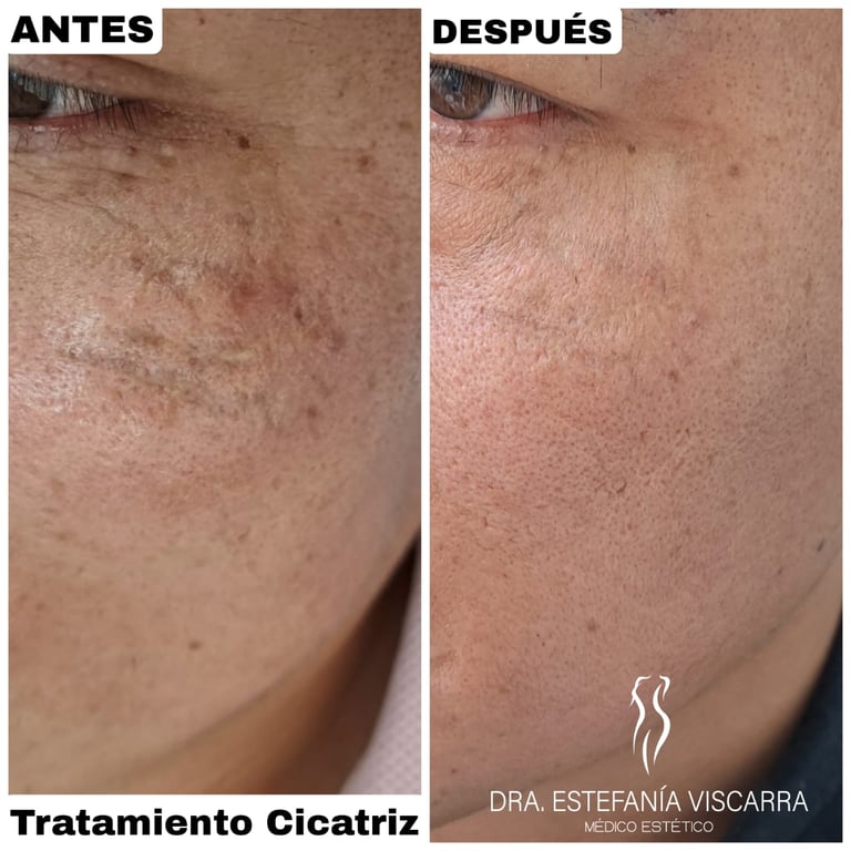 tratamiento cicatriz laser co2 fraccionado