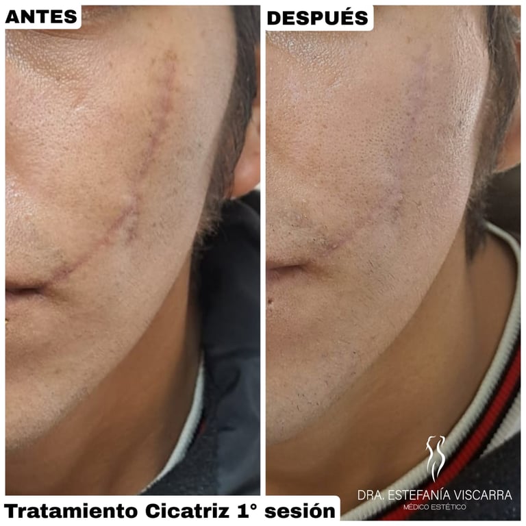 tratamiento cicatriz laser co2 fraccionado