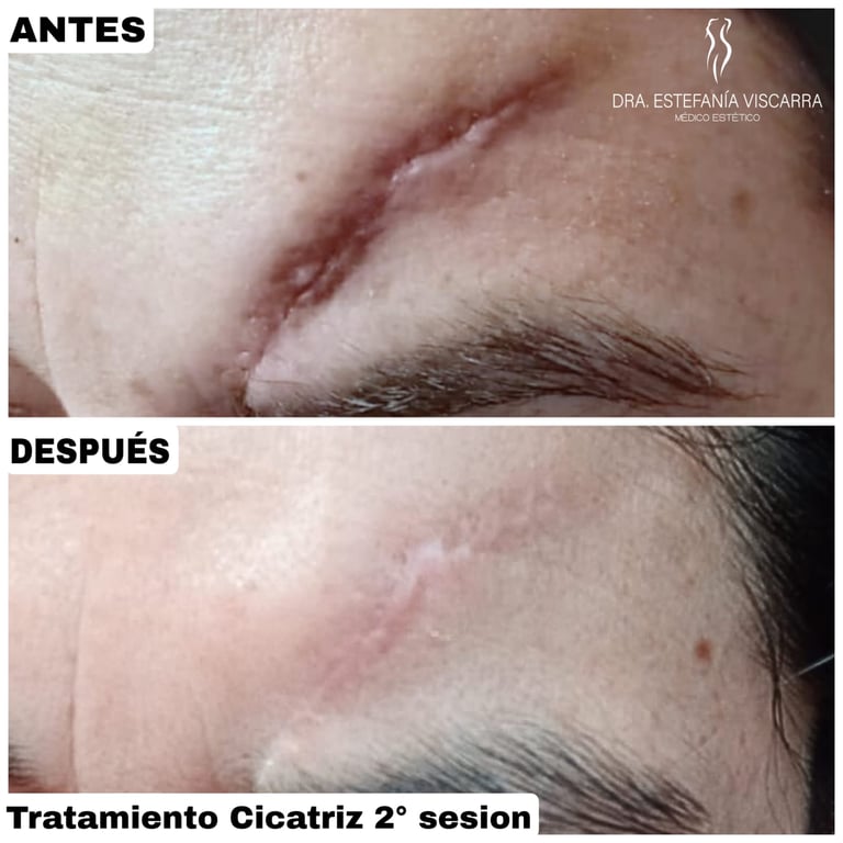 tratamiento cicatriz laser co2 fraccionado