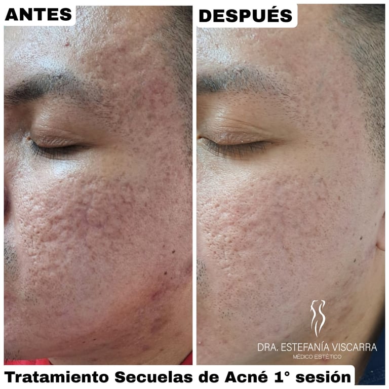 Secuelas de acné tipo rolling