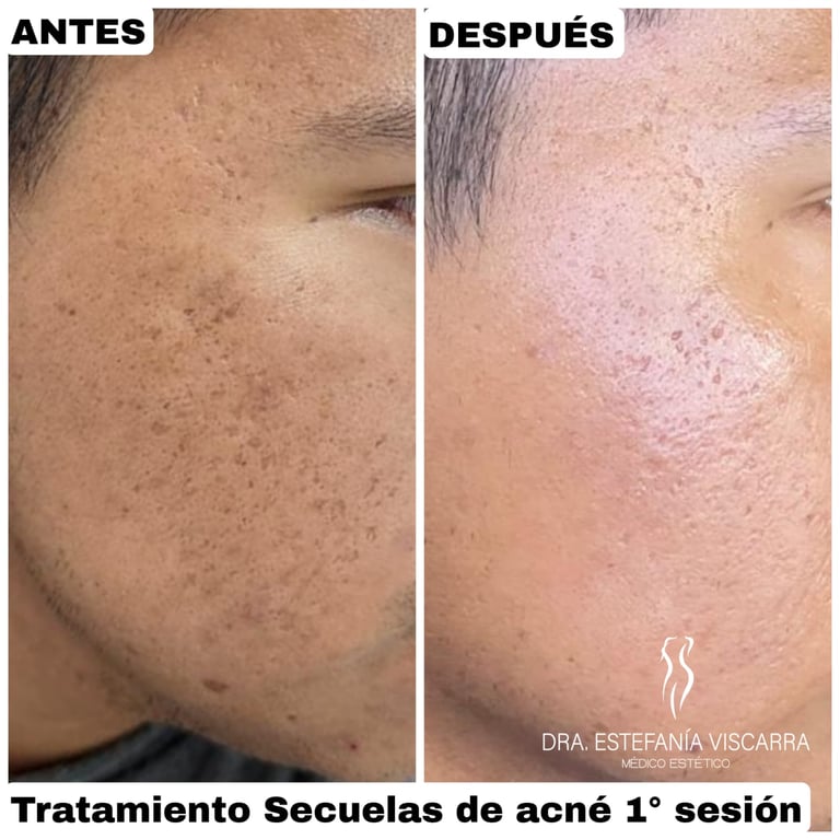 Secuelas de acné tipo picahielo