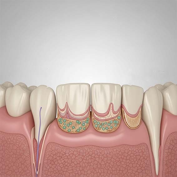 Alerte des dentistes sur les maladies des gencives hygiene-precision.com