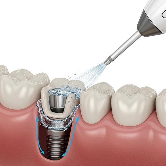 Entretien implant dentaire et hygiène implant dentaire hygiene-precision.com