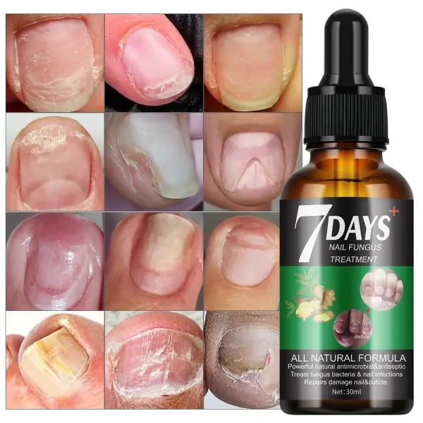 Nail Fungus Cures