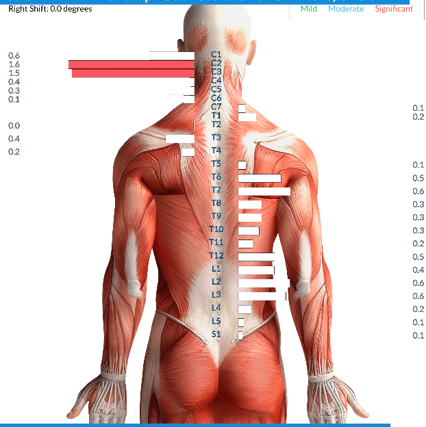 Vagus nerve stress from birth trauma causing tongue tie and latching issues