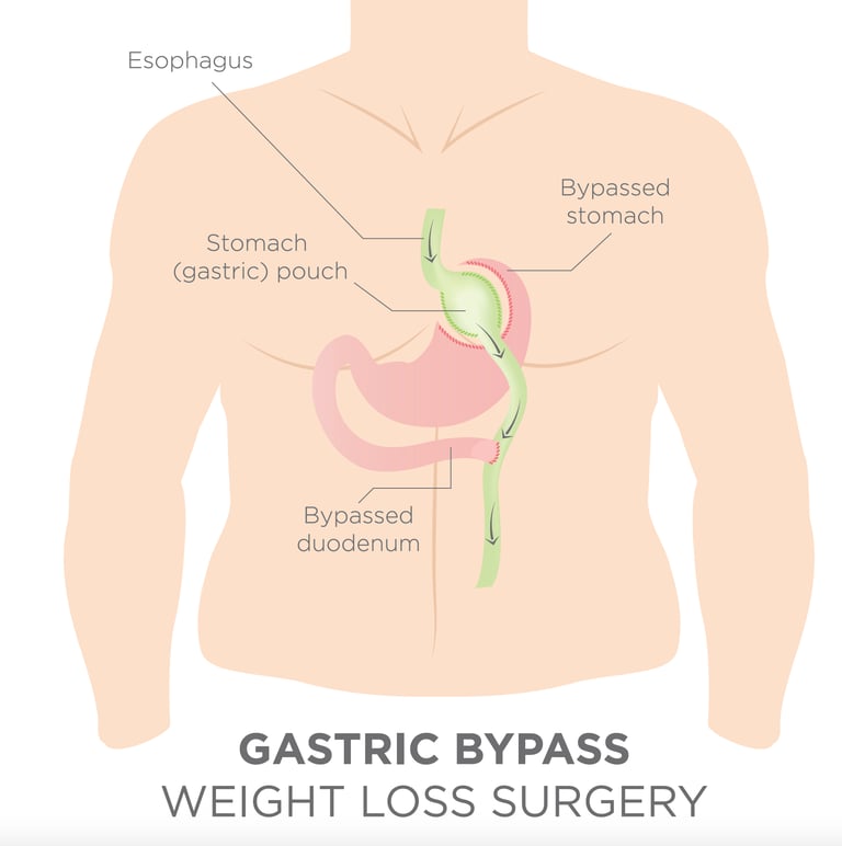illustration of gastric bypass