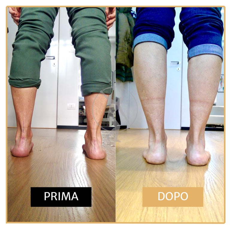 Tendinite e Fascite Plantare Performa Specialists by Dott. Alessandro Rossin