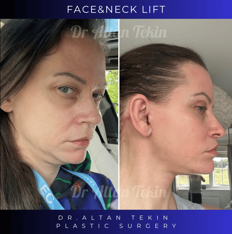 face lift before after pictures