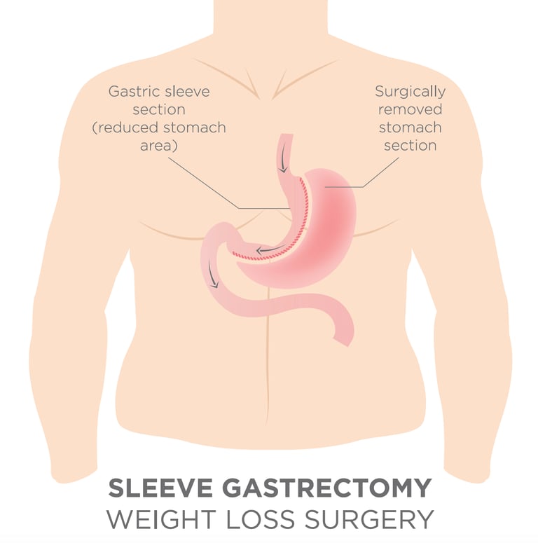 illustration of sleeve gastrectomy