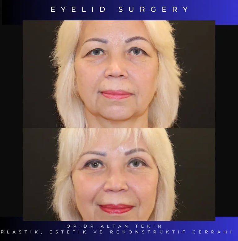before after photo eyelid surgery
