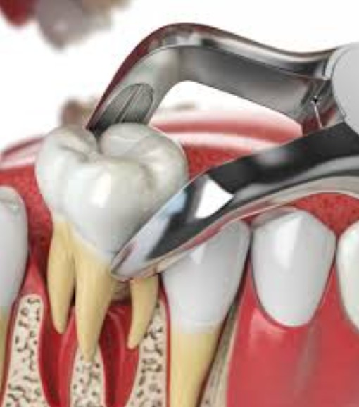 A dental model showing professional tooth extraction using forceps on a molar with roots.