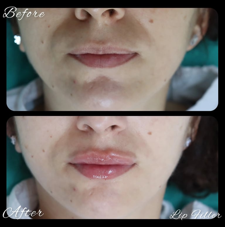 lip filler Antalya Turkey