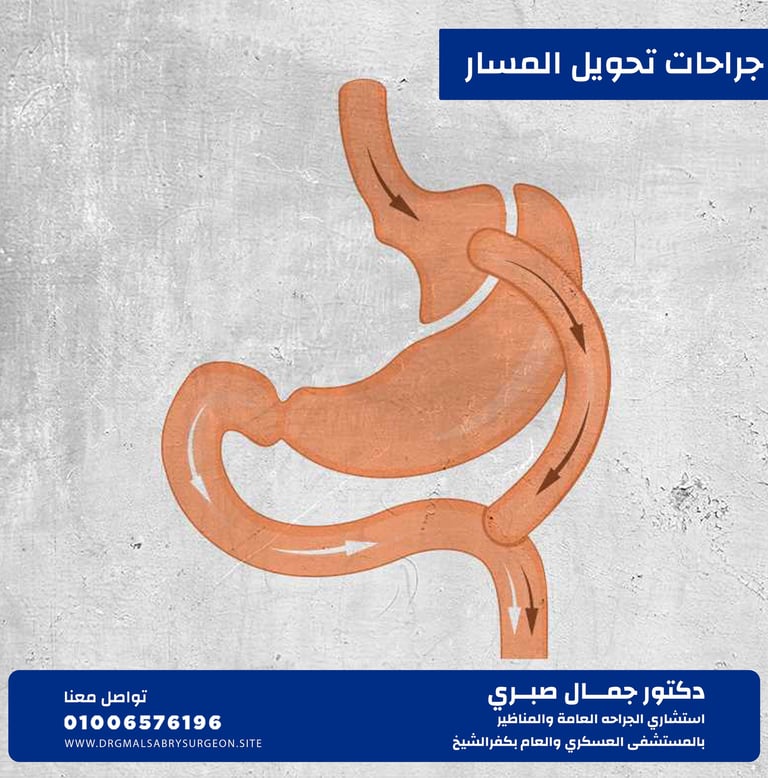 جراحات تحويل المسار كفرالشيخ