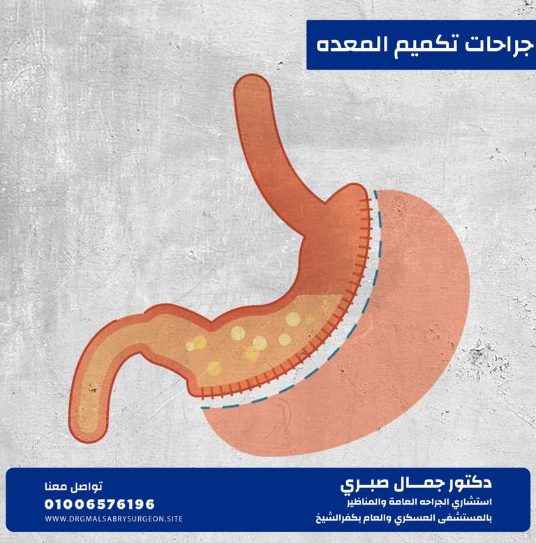 جراحات تكميم المعده كفرالشيخ