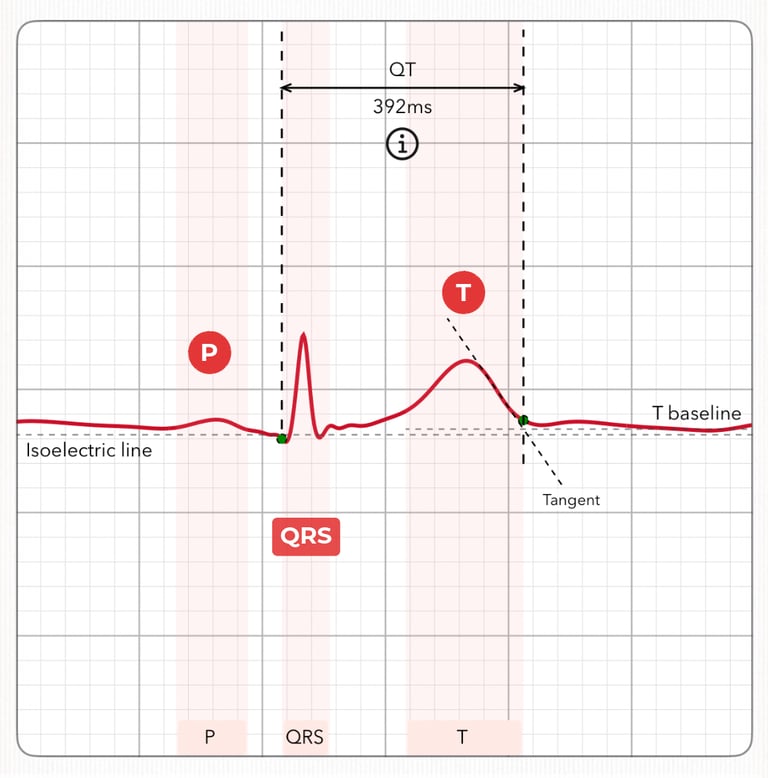 ECG heartbeat signature showing P, QRS, and T waves with Tangent line marked for QT measurement