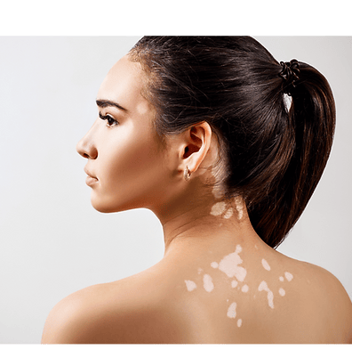 Harmonisation de la peau pour camouflage du vitiligo.