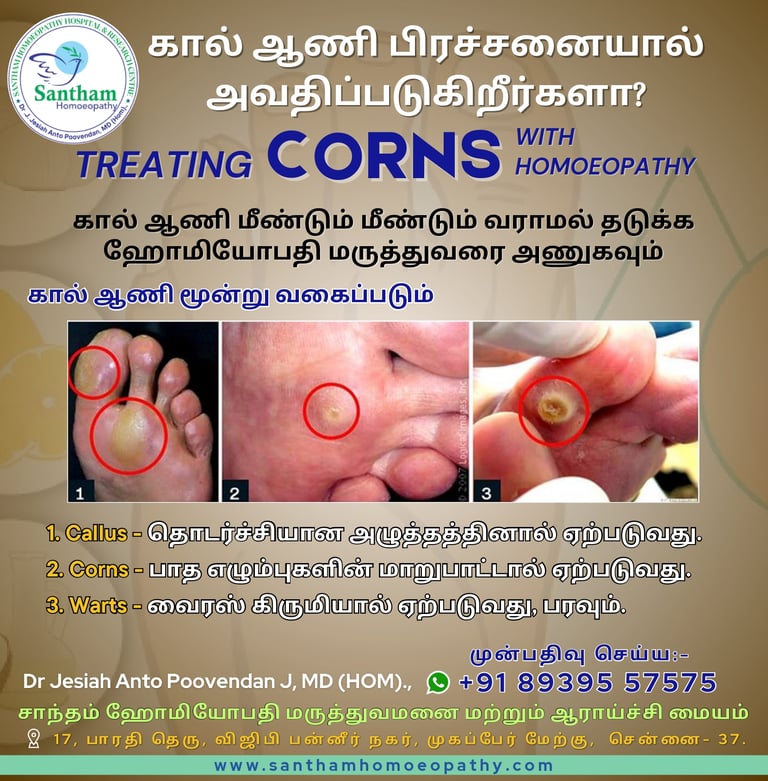 Foot Corn Homoeopathic medicine