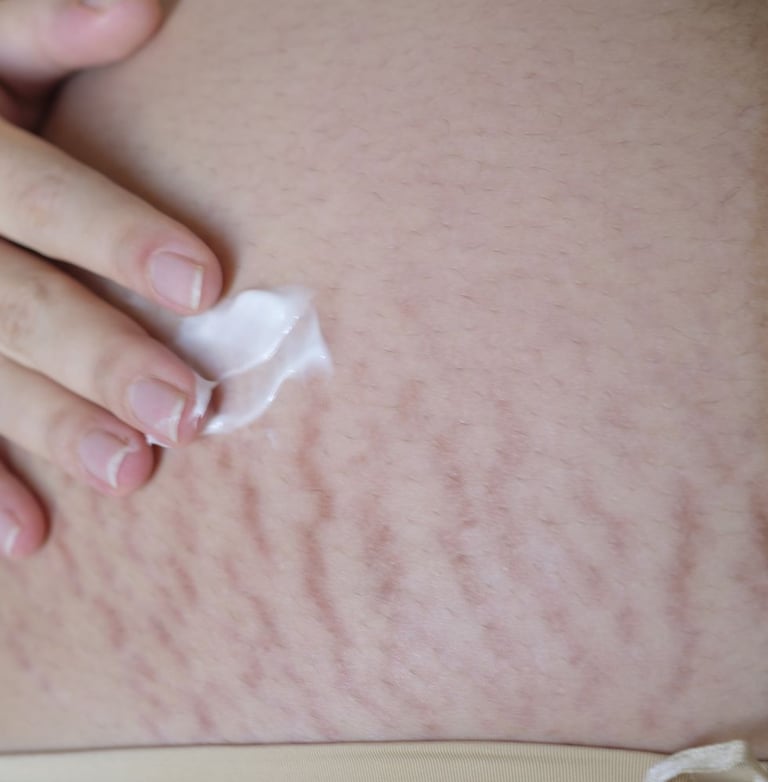 Résultat naturel du camouflage des vergetures post-grossesse.