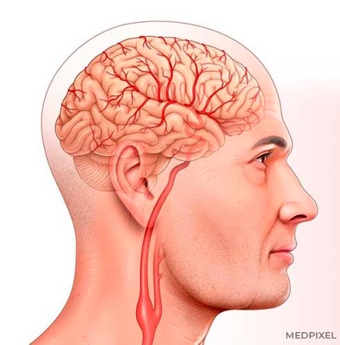 ilustracao medica neuroanatomia mostrando arteria carotida interna comum e cerebro