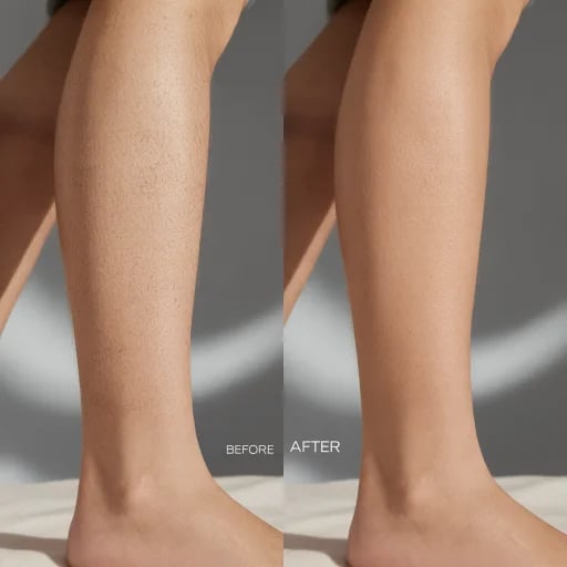 Protocolli epilazione laser personalizzati Lilium Palermo