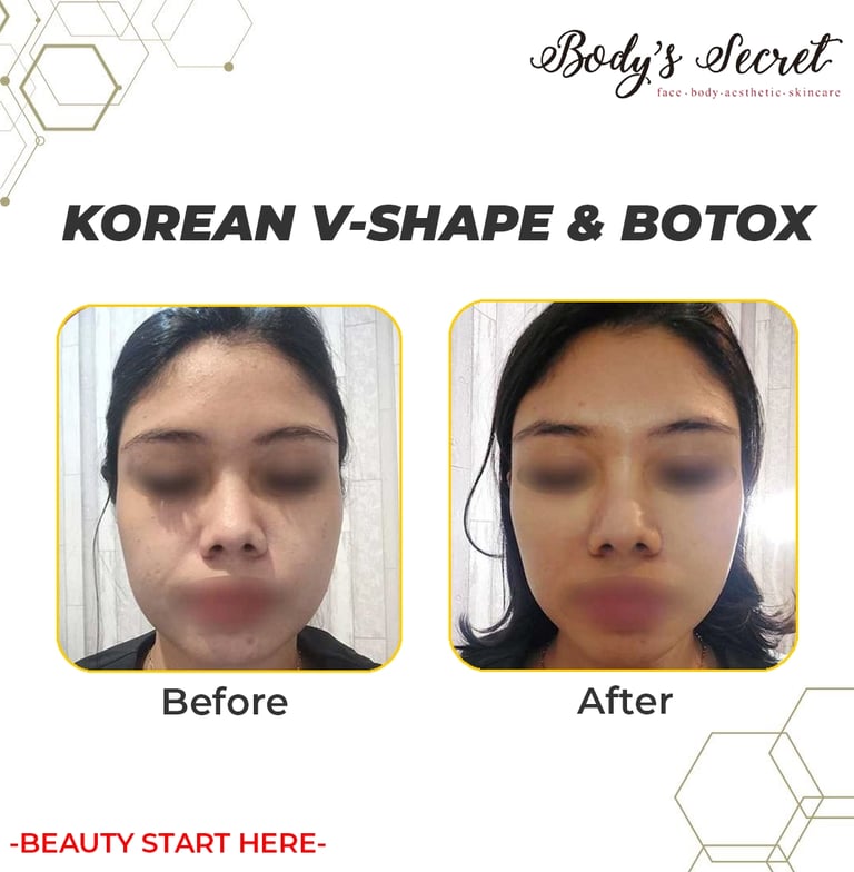 Body's Secret testimonial korean v shape and botox