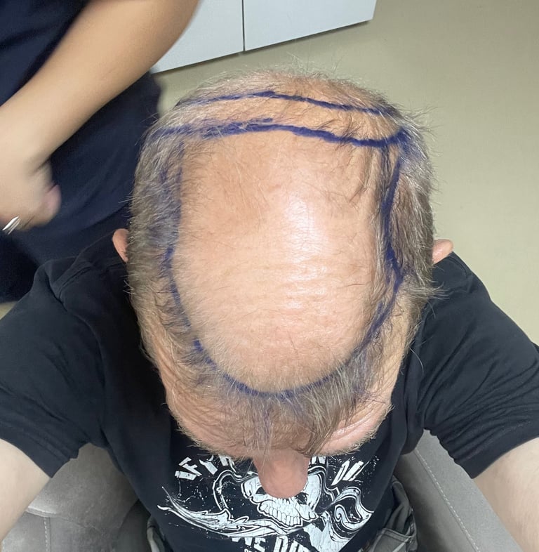 My head being prepared for hair transplant surgery in Izmir, Turkey
