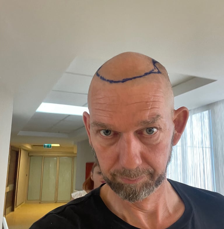 My head being prepared for hair transplant surgery in Izmir, Turkey